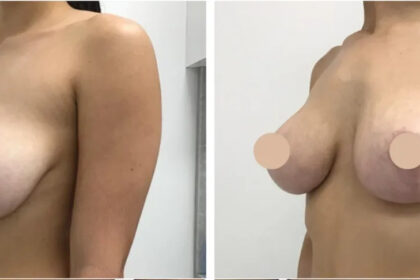 breast lift in dubai