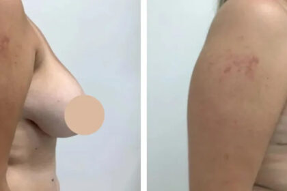breast reduction in dubai