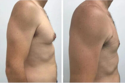 gynecomastia in dubai