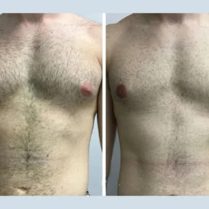 Best Doctors in Dubai for Teen Gynecomastia: What Parents Should Know