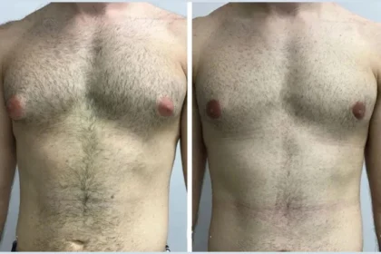 Best Doctors in Dubai for Teen Gynecomastia: What Parents Should Know