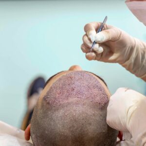 Hair Transplant