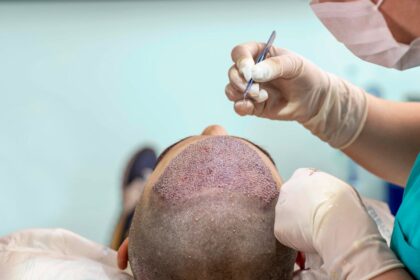 Hair Transplant