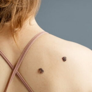 How Do You Care for Skin After Mole Removal