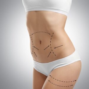 How Does a Tummy Tuck Address Loose Skin