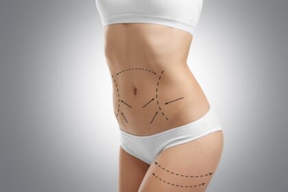 How Does a Tummy Tuck Address Loose Skin