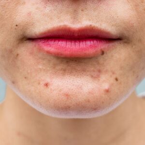 Is Pimples Treatment Good for All Skin Types