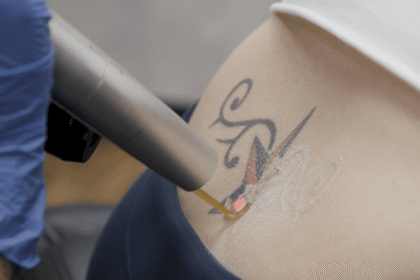 Picosure Tattoo Removal in Dubai