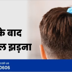 Best Hair Transplant in Delhi