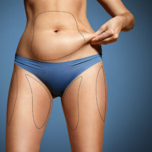 Liposuction in Dubai