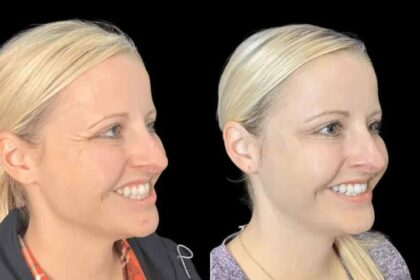Timeless Elegance Achieved with the Best Plastic Surgeon in Dubai for Botox