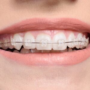 Teeth Braces Costs in Dubai