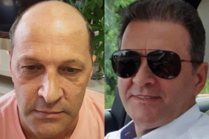 best hair transplant