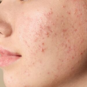 Can HydraFacial Treat Acne and Pimples?