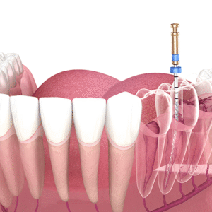 Root Canal Treatment in Dubai