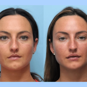 Experience the Best Plastic Surgeon in Dubai for Thread Lift Confidence