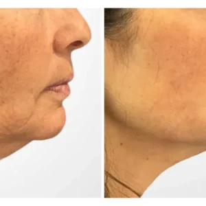 Is There Downtime After Thread Lift Treatments in Dubai?