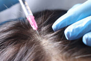 زراعة الشعر في الرياض
