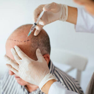 زراعة الشعر في الرياض
