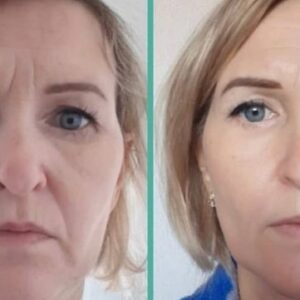 7D Hifu facial treatment
