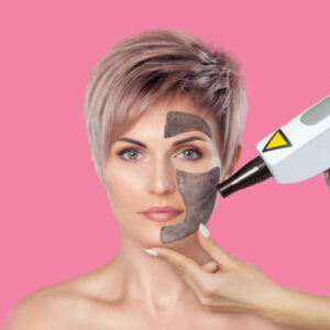 Can Laser Carbon Peel Help Control Acne Breakouts