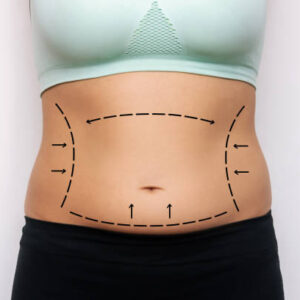 Can Laser Liposuction Treat Fat Without Scars