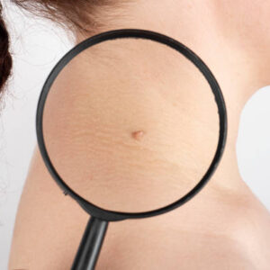 Does Warts Removal Treatment Leave Scars