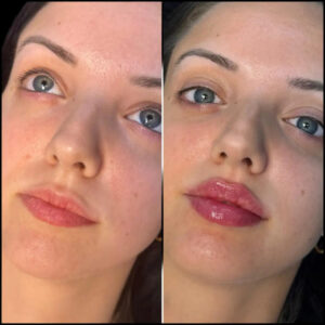 fillers in dubai,