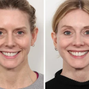 Why Choosing the Best Plastic Surgeon in Dubai Matters for a Thread Lift