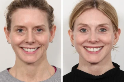 Why Choosing the Best Plastic Surgeon in Dubai Matters for a Thread Lift