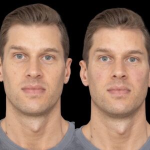 under eye fillers in dubai