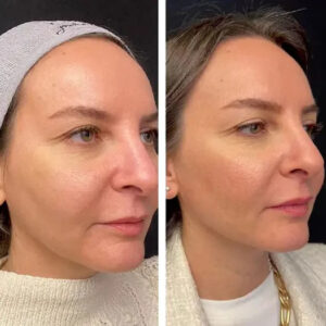 Mesotherapy in dubai