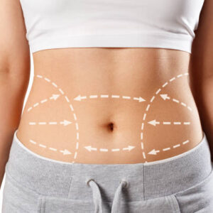 How Liposuction Improves Body Contours