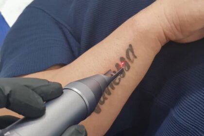 Is Laser Tattoo Removal the Best Tattoo Removal Option