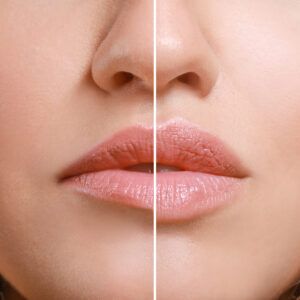 Lip Enhancement Techniques for Natural, Fuller Lips