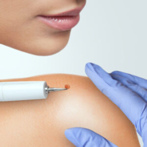 Skin tag removal in Dubai