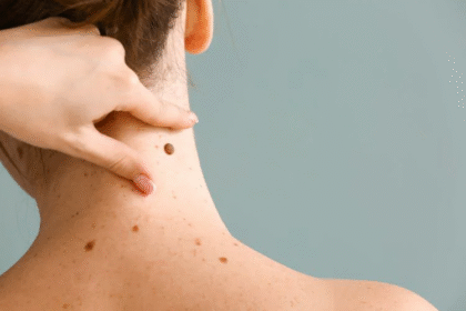 Skin Lesion Removal for All Skin Types