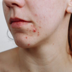 The incredible impact of Acne treatment
