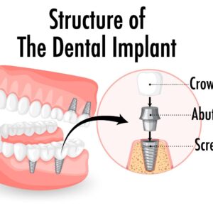 Why the Best Dental Implants Are Worth Every Penny