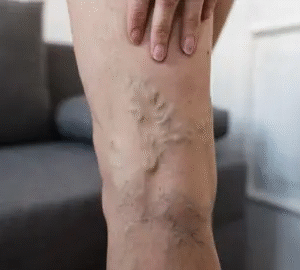 Varicose Veins Treatment Say Hello to Healthy Legs