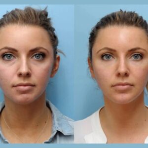 Restore Confidence and Elegance with Thread Lift Treatment in Dubai