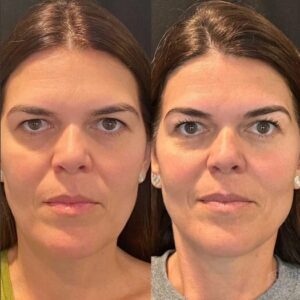 Thread Lift Treatments in Dubai: The Secret to a Youthful Glow
