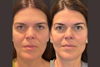Thread Lift Treatments in Dubai: The Secret to a Youthful Glow