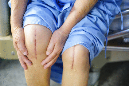 Advanced Techniques in Knee Replacement Surgery