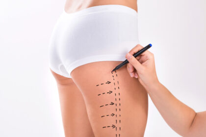 vaser 4D liposuction in dubai