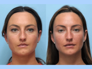 Thread Lift Treatment in Dubai for Skin Tightening and Collagen Boost