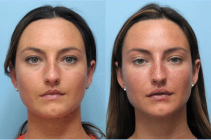Thread Lift Treatment in Dubai for Skin Tightening and Collagen Boost