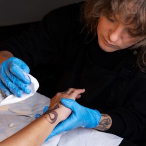 laser tattoo removal