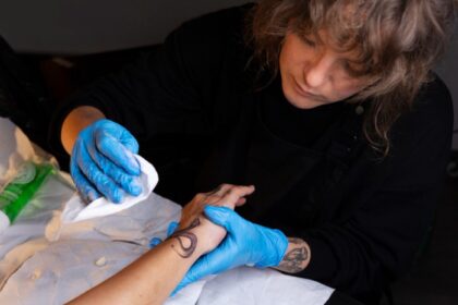 laser tattoo removal