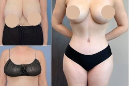 Tummy Tuck in dubai